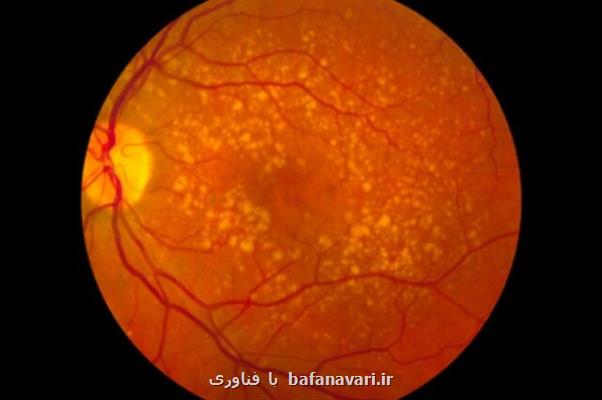 نقص عملکرد پروتئین تنظیم سیستم ایمنی علت شایع نابینایی در بزرگسالان