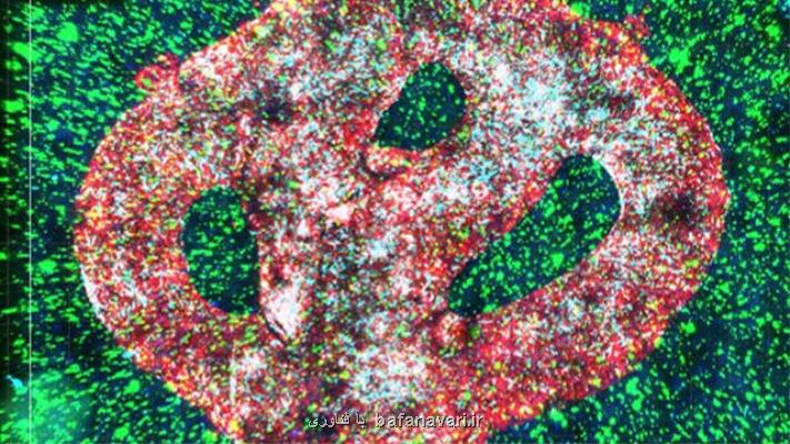 اولین چاپ 3 بعدی تومور مرگبار مغزی