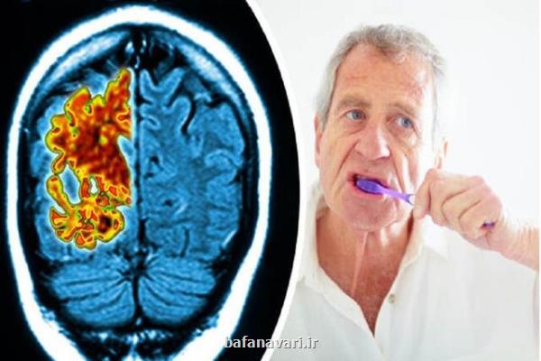 تایید ارتباط مبتلاشدن به آلزایمر با باکتری های دهان