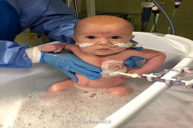 درمان عارضه قلبی یک نوزاد با سلول های بنیادی جفت جنین برای نخستین بار