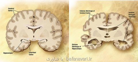 ارتباط میان بیماری های مزمن چشم و آلزایمر